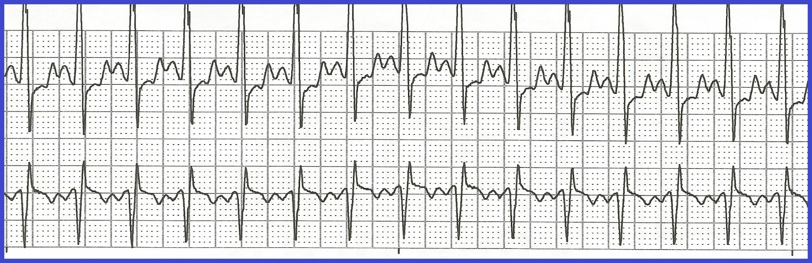 Sinus tachycardia.jpg