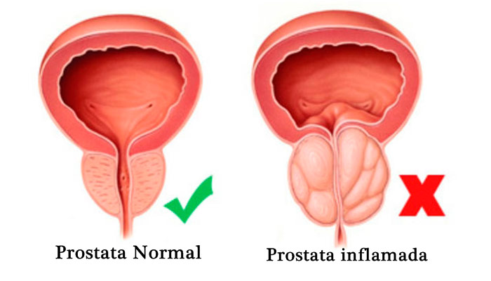que-es-la-prostata.jpg