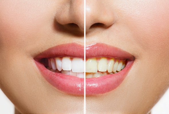 white-teeth-vs-yellow-teeth.jpg