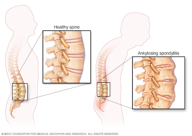 ds00483_im03685_mcdc7_ankylosing_spondylitisthu_jpg.png