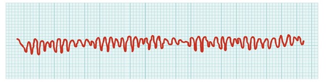 2024_Cardiac_Arrhythmias_640x165.jpg