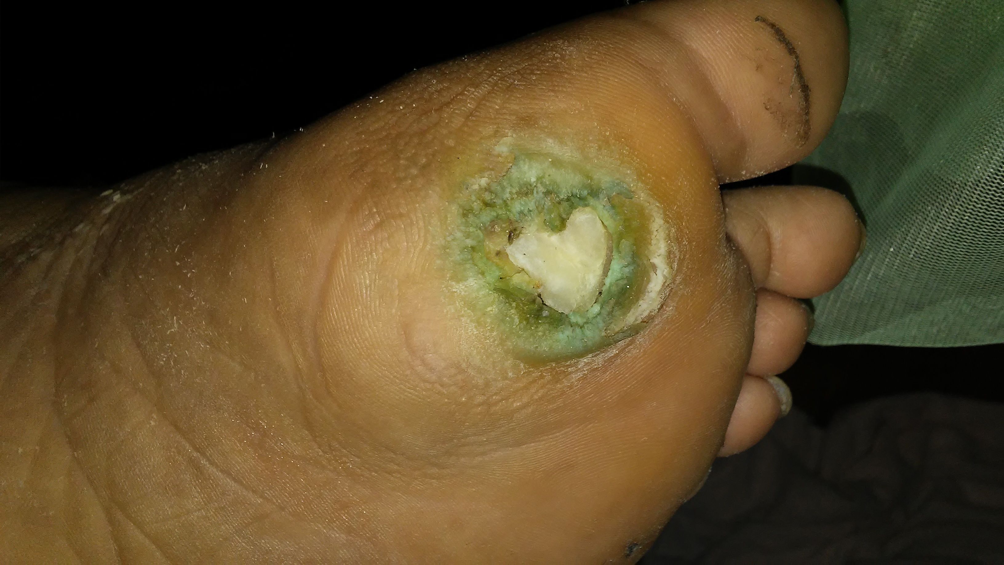 my diabetic sister's foot.jpg