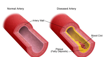 circulatory-system-diseases-thumb.jpg