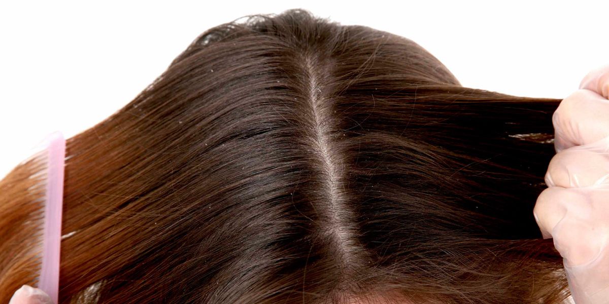 Dandruff.jpg