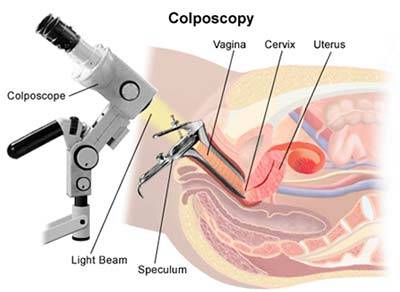 colposcopy.jpg