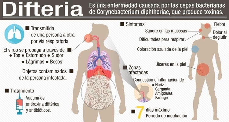 difteria.jpg