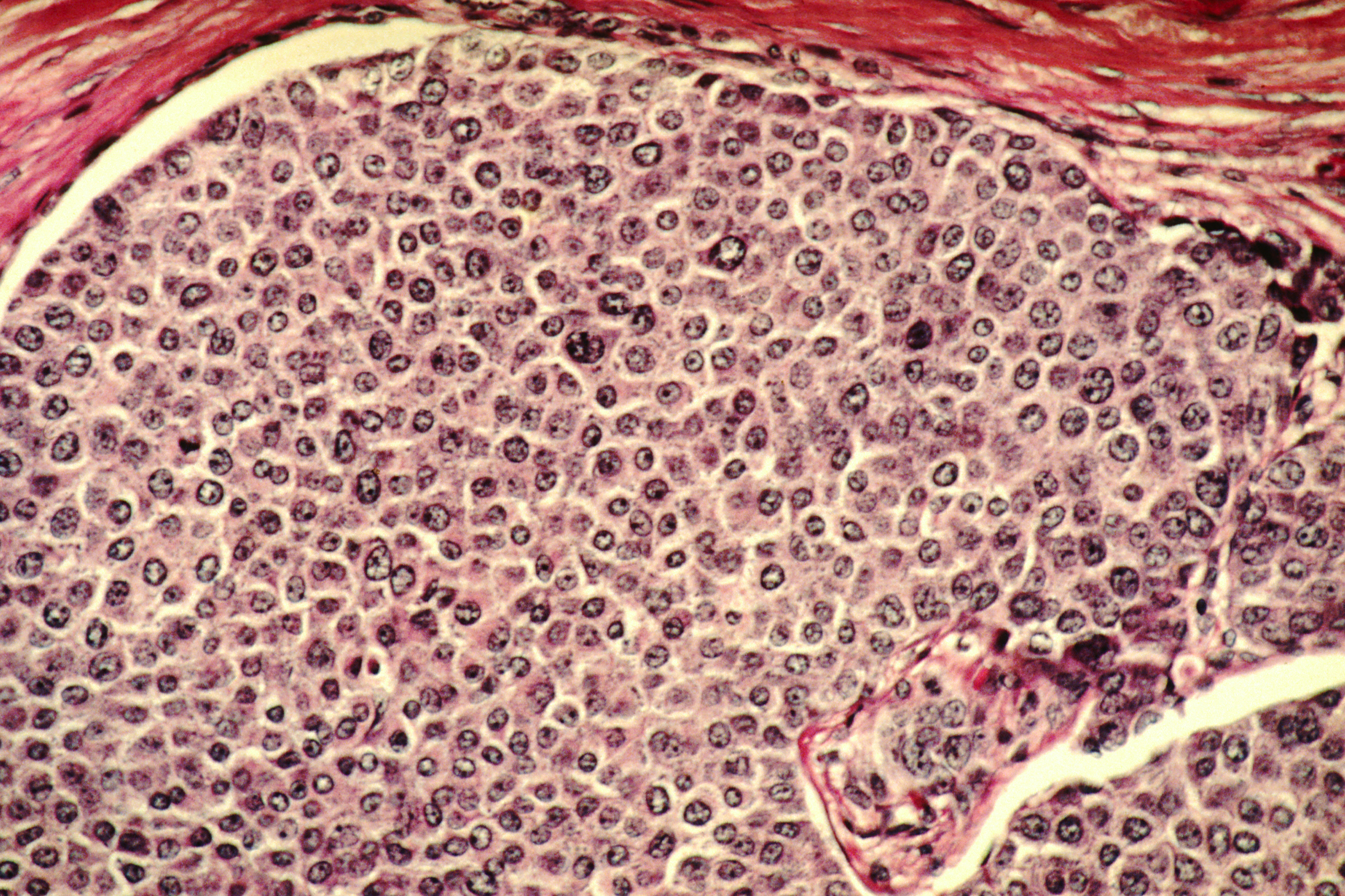 Breast_cancer_cells.jpg