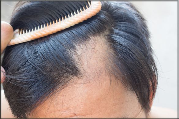 Alopecia Areata Treatment Tips - Buzzertop — Steemit