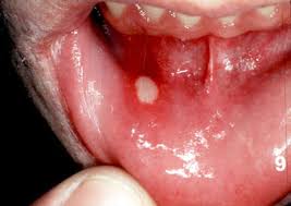 canker sore.jpg