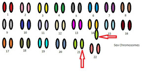 Translocation-DS-Karyotype-1-300x152.jpg