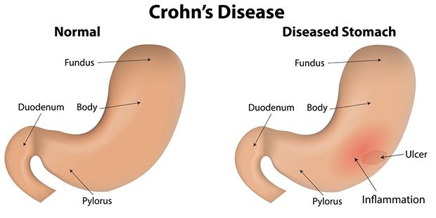 Crohns_Facts_620x310.jpg