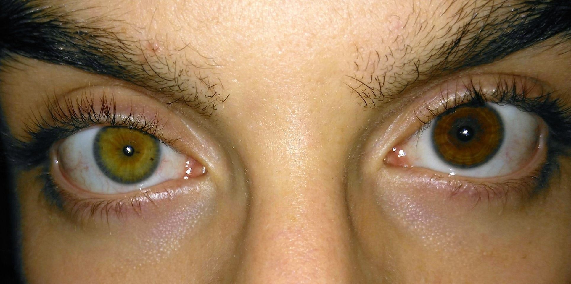 Complete_heterochromia_plus_anisocoria.jpg