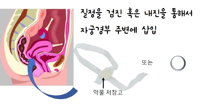 유도분만.jpg