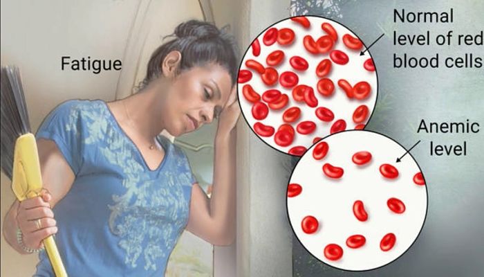 anemia-2_opt.jpg