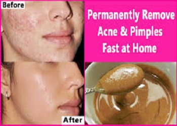 The-real-way-to-get-rid-of-acne.jpg