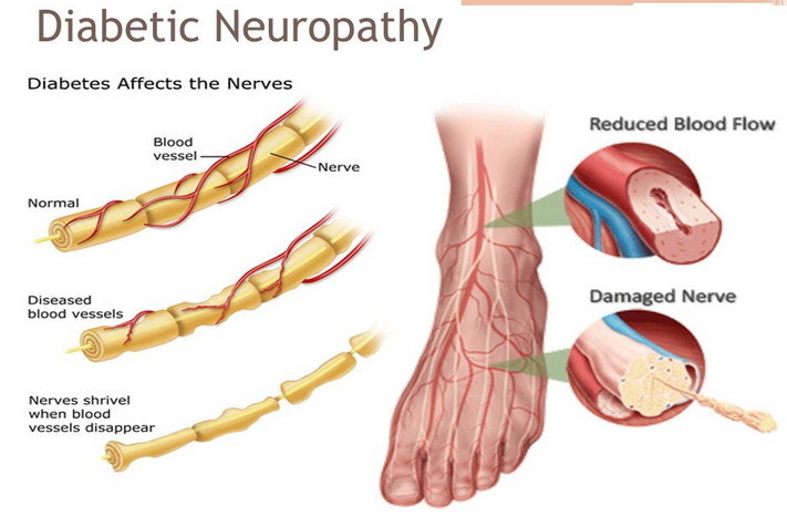 Diabetic-Neuropathy-In-Kerala.png