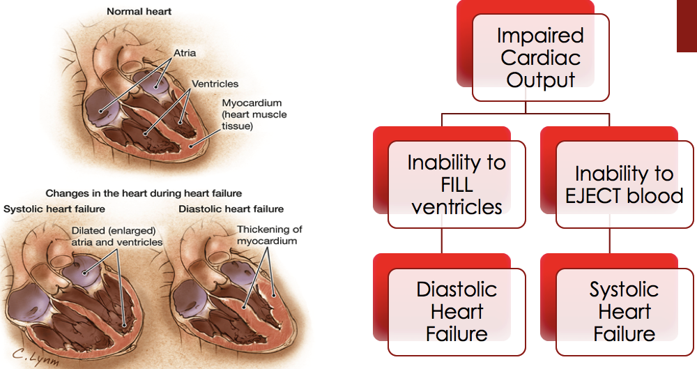 Heart Failure terminology.png