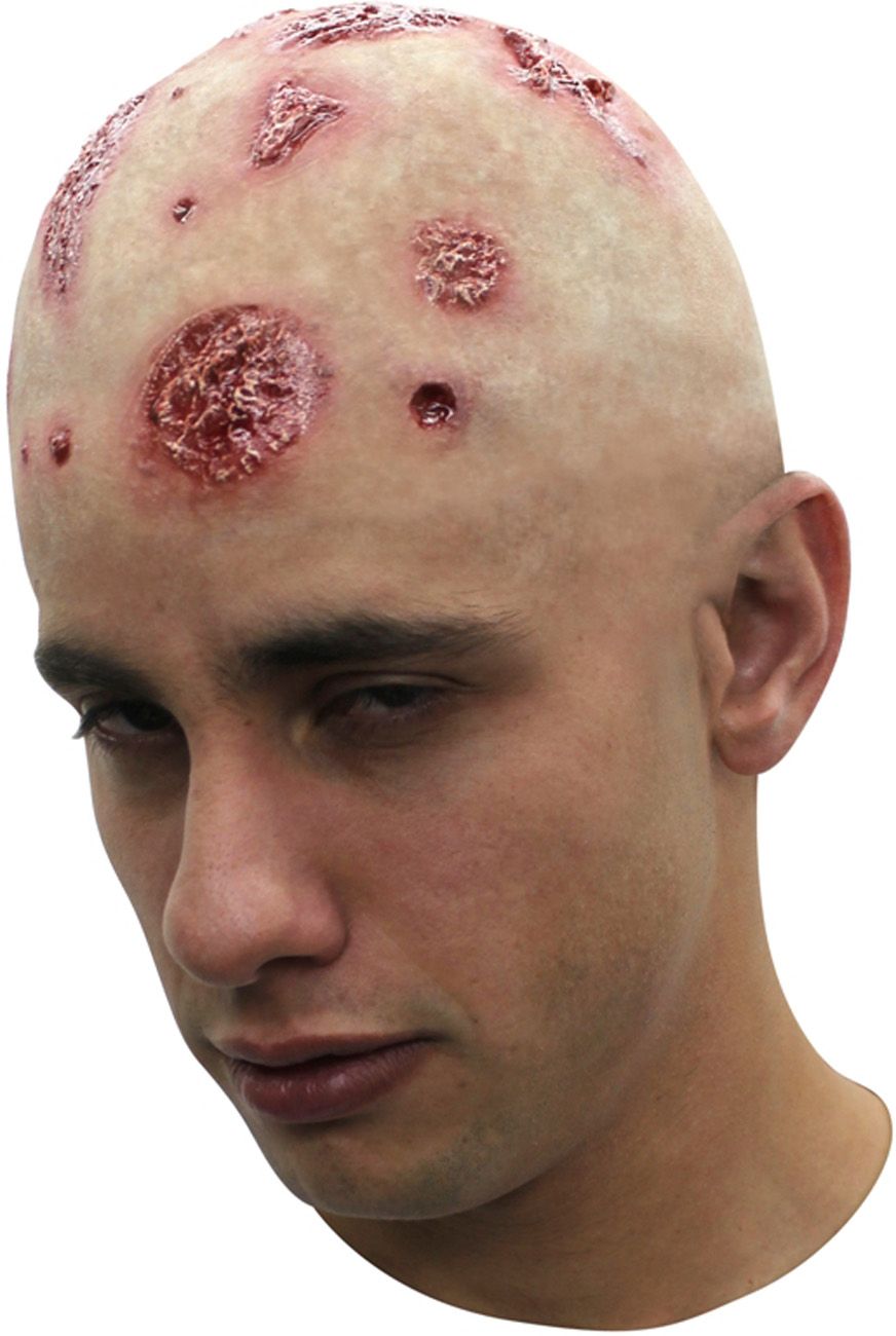 Bald head with scabs.jpg