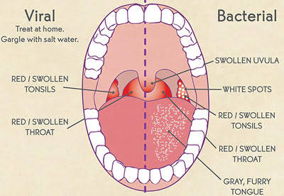 RACGP - An unusual case of sore throat