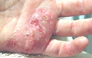eczema infections.jpg