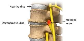 Degenerative Disc Disease Threpeutics Market.jpg