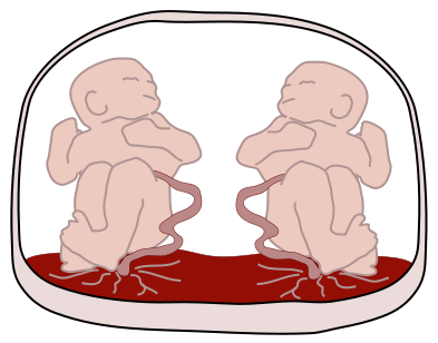 Monochorionic_monoamniotic_twins.png