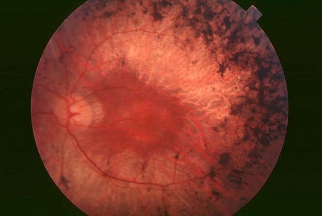 5-retinitis-pigmentosa.jpg