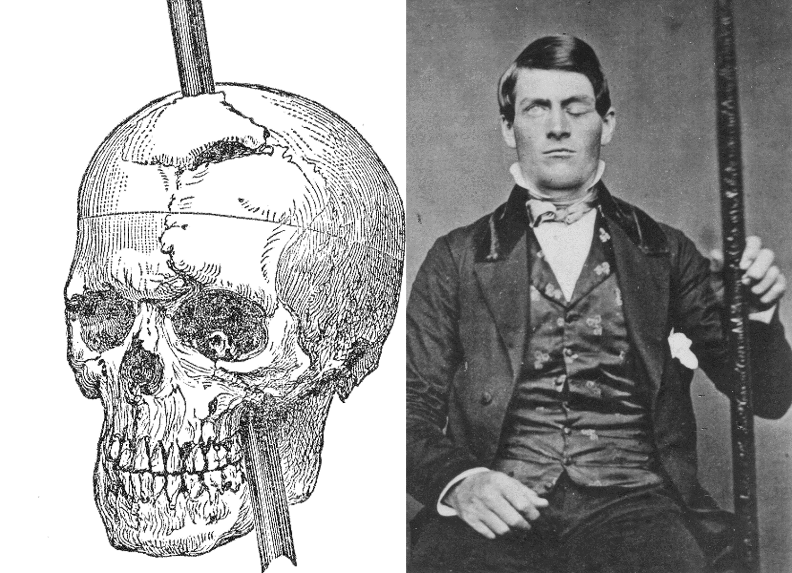 Phineas-Gage-with-skull-picture.png