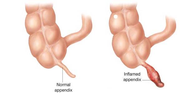 DrThind_Appendicitis_chd.jpg