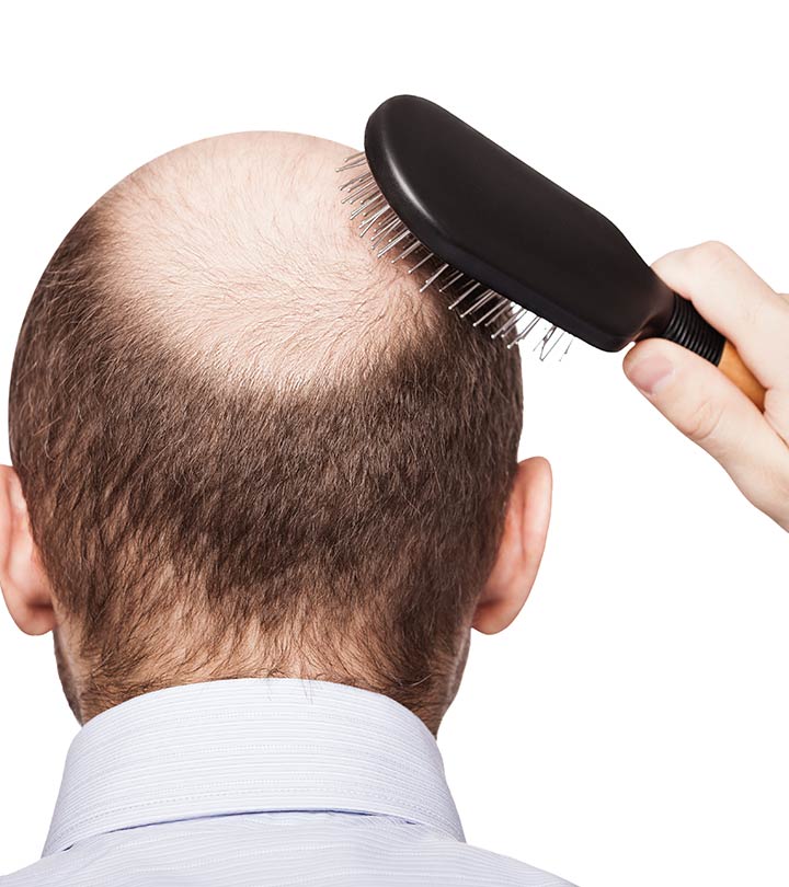 What-Is-DHT-Hair-Loss-And-How-To-Treat-It-1.jpg