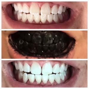 charcoal teeth.jpg