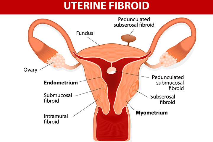 uterine-fibroids-and-pregnancy.jpg