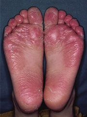 Juvenile planter dermatosis.jpg