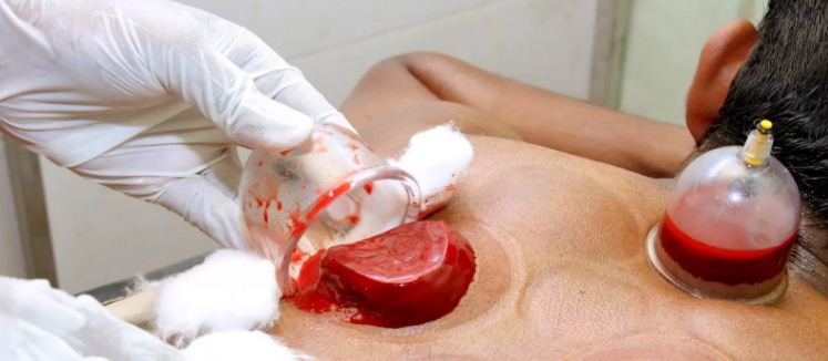 hijama.JPG