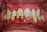 periodontitis patient at dr swarups.jpg
