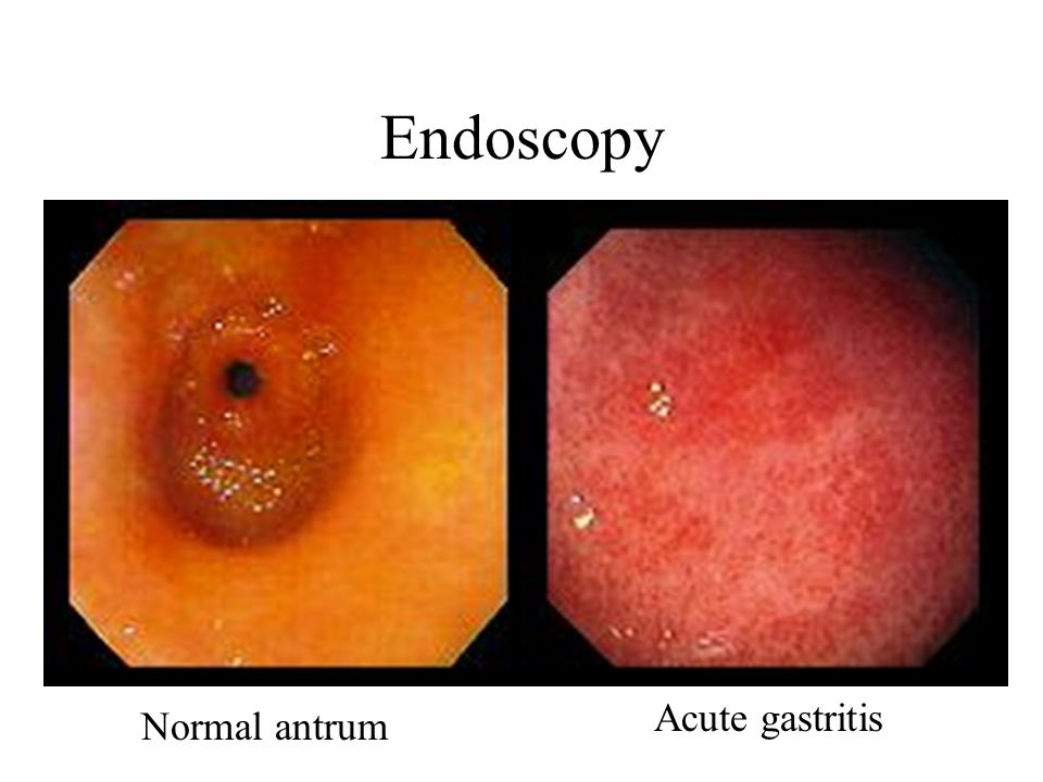 endoscopia.jpg