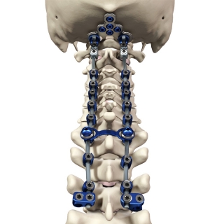 Spine Fixation.jpg