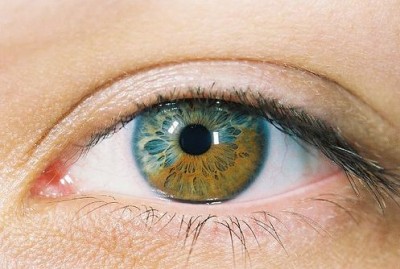 Sectoral-Heterochromia-.jpg