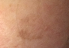 melasma_article_after2.jpg