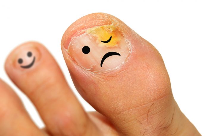Onychomycosis-fungal-infection-of-the-nail-696x459.jpg