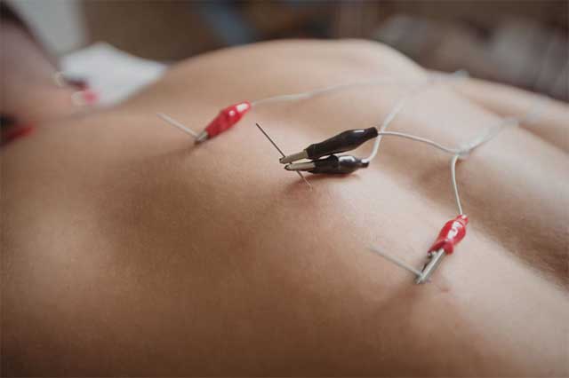 66511_acupuncture.jpg