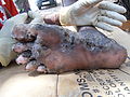 120px-Jigger_infested_foot_(2).jpg