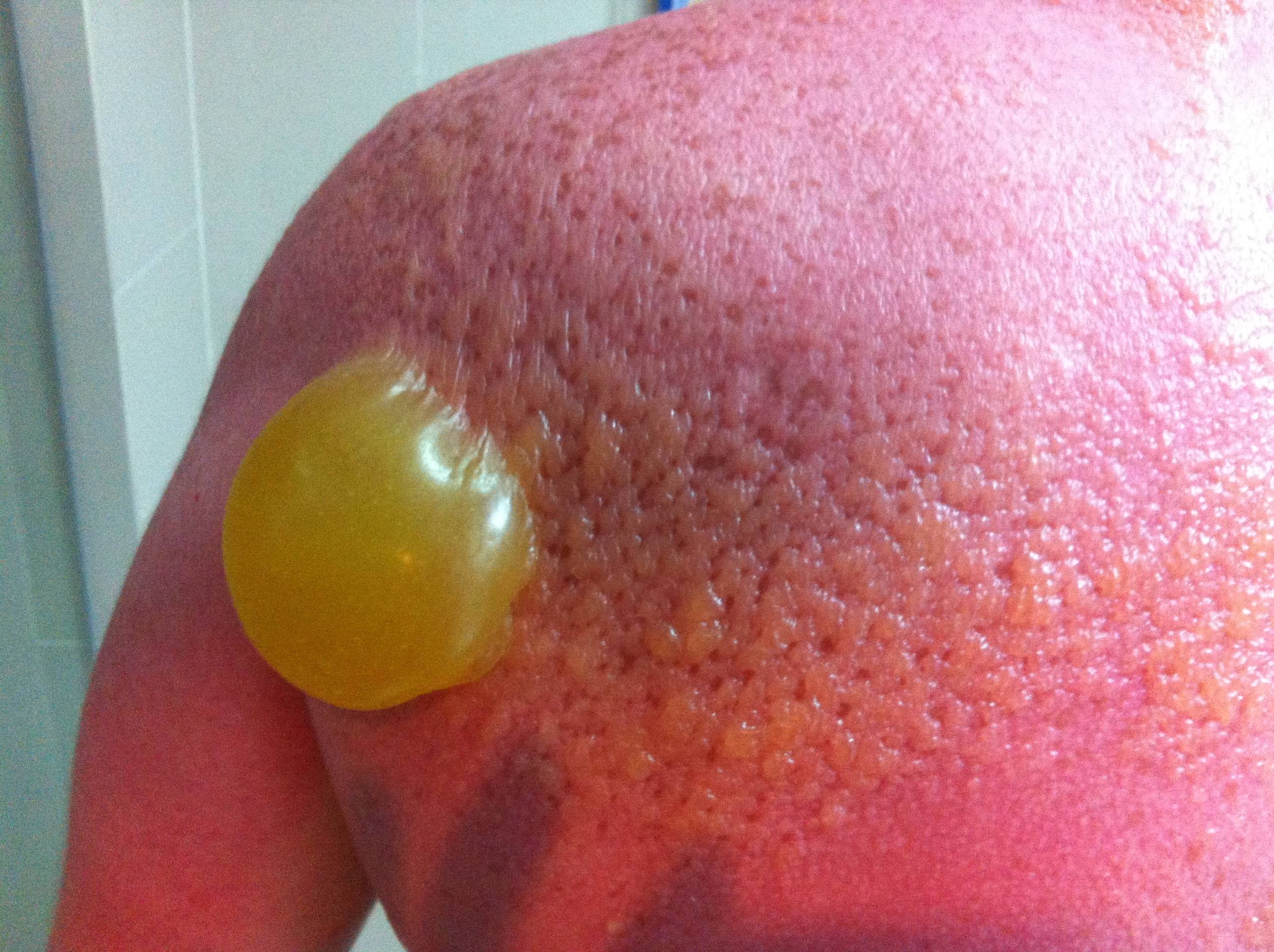 severe sunburn 2.jpg