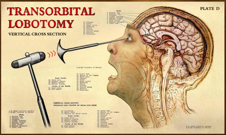 lobotomy.png