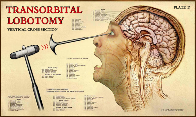 Lobotomy 