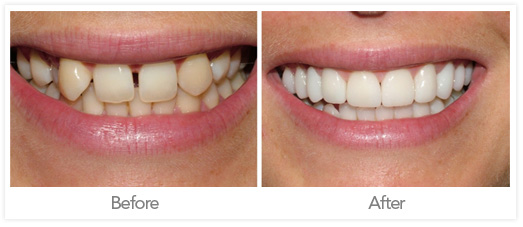 dental-crown-before-after.jpg