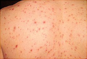 280x190_capd_vericella_chickenpox_ref_guide.jpg