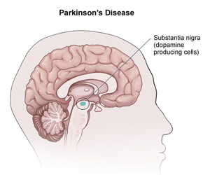 parkinsonova-bolest-300x250.png