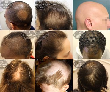 Male-Hair-Loss-Other-Hair-Loss-Conditions-The-Belgravia-Centre1.jpg