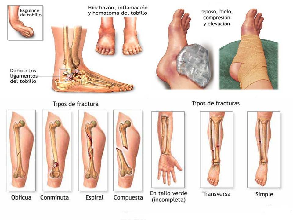 fracturasesguinces-lesiones-oseas.jpg